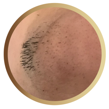 Epilevolution - Tratează foliculita