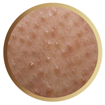 Epilevolution - Tratează foliculita