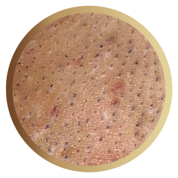 Epilevolution - Tratează foliculita