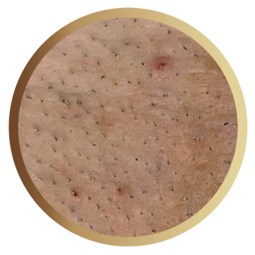 Epilevolution - Tratează foliculita